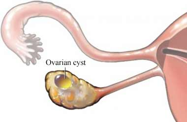 Ovarian-Cyst Dr Aindri Sanyal